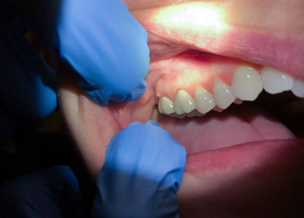 Best Chipped Tooth Repair Near Me  in Poland, OH